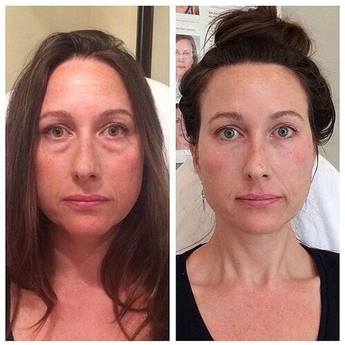 Girls before and after laser facial rejuvenation