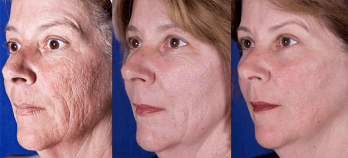 The result after a laser facial skin rejuvenation procedure