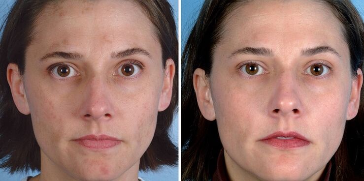 before and after skin rejuvenation with tools