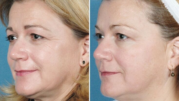 pictures before and after hardware skin rejuvenation