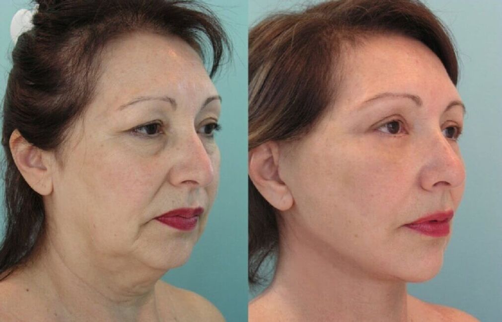 pictures before and after skin rejuvenation